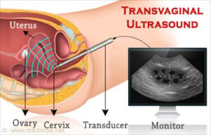 Understanding Transvaginal Ultrasonography: A Comprehensive Guide