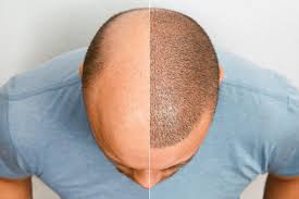 Regain Your Confidence: The Comprehensive Guide to Hair Transplant in Islamabad