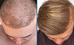 Best Hair Transplant in Lahore Comprehensive Guide to Top Clinics and Surgeons