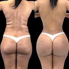 Liposuction for Hips and Buttocks in Dubai