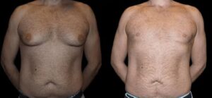 Right Compression Garments After Male Breast Reduction Surgery
