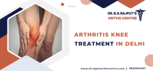 Arthritis Knee Treatment in Delhi: A Comprehensive Guide